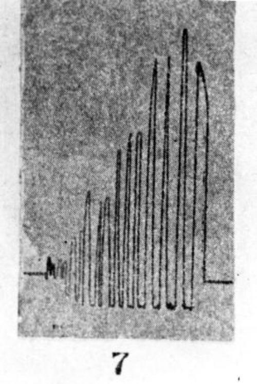 Black and white image of a tracing of a knee-jerk reflex